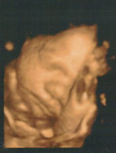 Schwangerschaft 3D-Ultraschallbild - Gynäkologie, Frauenarzt in Burg Stargard