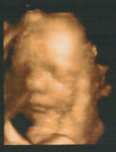 Schwangerschaft - 3D-Ultraschallbild - Gynäkologie, Frauenarzt in Burg Stargard
