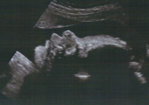 Schwangerschaft Ultraschallbild - Gynäkologie, Frauenarzt in Burg Stargard